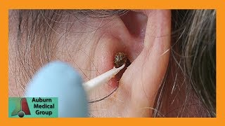 Chunky Earwax Removal  Auburn Medical Group [upl. by Iruy395]