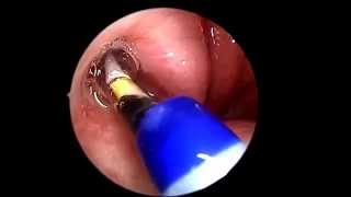 Eustachian Tube Balloon Dilation [upl. by Ehtyde]