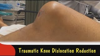 Traumatic Knee Dislocation ReductionQuick Version [upl. by Weig]