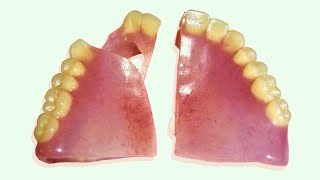 How to Repair a Broken Denture in 25 Minutes [upl. by Zawde]