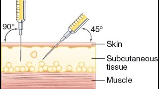 Subcutaneous Injection Demonstration [upl. by Juline]