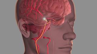 Nasal Intubation [upl. by Nepean679]