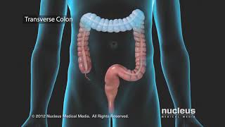 Colon Problems Diverticular Disease [upl. by Muraida584]