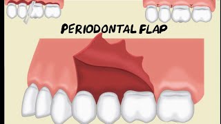 Periodontal Flap [upl. by Yendroc186]