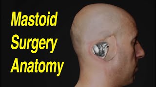 Explaining Cholesteatoma [upl. by Hteik]