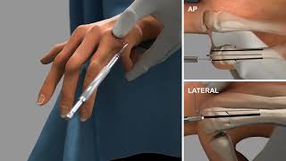 Bioretec ActivaPin™ 5th Metacarpal fracture fixation [upl. by Teddie770]