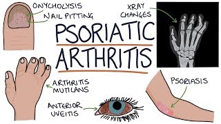 Psoriatic Arthritis [upl. by Aceber]