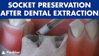 Tooth extraction  Treatment for socket preservation © [upl. by Suirad]