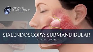 Sialendoscopy for Submandibular Gland Stones [upl. by Lednik]