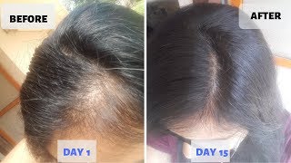 OMG  15 Days Hair Growth Miracle Treatment  Grow Long Thicken Hair  100 works [upl. by Kelcy401]