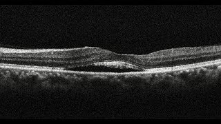 Photodynamic Therapy in Chronic Central Serous Chorioretinopathy  Retina Center Tijuana Mexico [upl. by Joe]