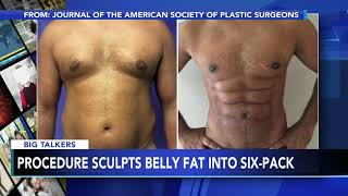 New procedure uses foam to sculpt belly fat into 6pack abs [upl. by Thorncombe]