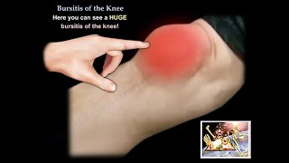 Prepatellar Bursitis Anterior knee pain and swelling [upl. by Aramat]