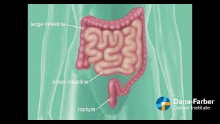 Colon Cancer Surgery What You Need to Know [upl. by Nnylhtak]