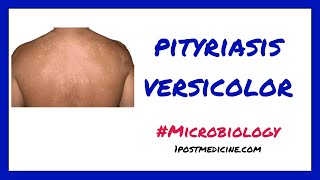 Pityriasis Versicolor  Microbiology [upl. by Ahsirahc]