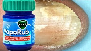 How To Treat Toenail Fungus With VICKS VAPORUB [upl. by Marci]