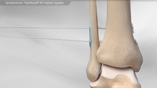 Syndesmosis TightRope® XP Implant System [upl. by Oehsen]