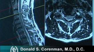 How to Read a MRI of Cervical Nerve Compression  Neck Pain  Colorado Spine Surgeon [upl. by Arahs]