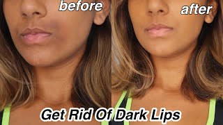 How To Get rid Of Dark Lips And Pigmentation [upl. by Uriisa]