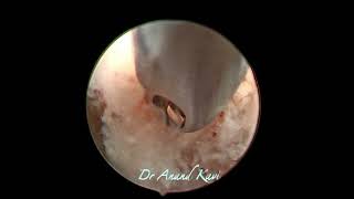 Treatment of Cauda Equina with Spine Endoscopy [upl. by Dedrick941]