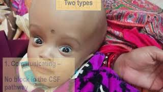 Hydrocephalus in children  Pediatrics [upl. by Garneau]