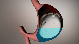 What Is a Gastric Balloon and How Does It Work [upl. by Adna]