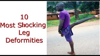 10 Most Shocking Leg Deformities [upl. by Onit]