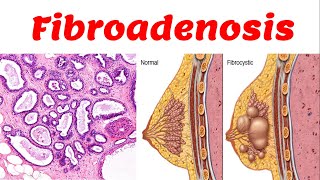 4 Fibrocytic Disease  Fibroadenosis [upl. by Eednam]