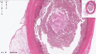 Acute Appendicitis  Histopathology [upl. by Nosahc]