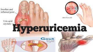 Hyperuricemia  Hyperuricemia Cause  Hyperuricemia Symptoms  Hyperuricemia Diagnosis amp treatment [upl. by Crary]