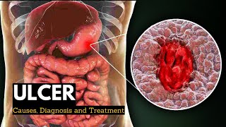 Ulcer Causes Signs and Symptoms Diagnosis and Treatment [upl. by Iuq261]