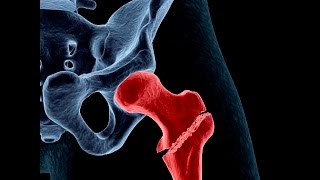 Treating Osteoporosis or Low Bone Density [upl. by Elac713]