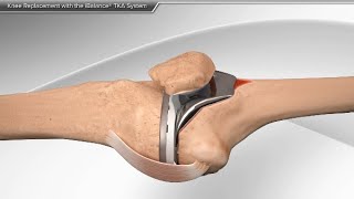 How To Tape amp Stop Kneecap Pain Patellofemoral Pain Syndrome [upl. by Alanna731]