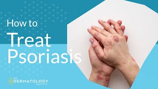 Psoriasis Treatment  Explained by Dermatologist [upl. by Raf750]