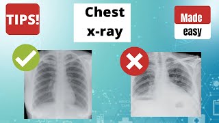 Chest x ray  How to read a Chest x ray TIPS [upl. by Rosie568]