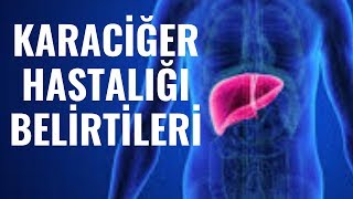 Karaciğer HastalıIğı Belirtileri Nedenleri Serdar Akgün Sağlıklı Yaşam [upl. by Ahsiruam]