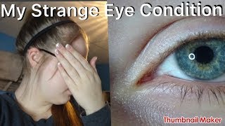 My Strange Eye Condition  Myopia  Astigmatism [upl. by Tiphane340]