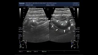 Inflamed Appendix Localization by Ultrasound [upl. by Acnoib123]