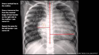 How to measure Cardiomegaly in CXR [upl. by Ecirtnom]