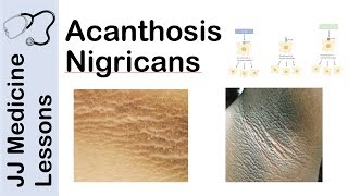 Acanthosis Nigricans  Risks Pathogenesis and Treatments [upl. by Serrell]