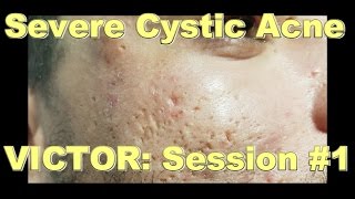 Severe Cystic Acne  Victor Session 1 [upl. by Annaek727]