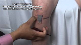 Knee Injection  Anterior Approach [upl. by Hardwick]