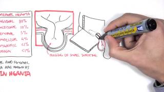 Introduction to Direct and Indirect Inguinal Hernia [upl. by Granniah720]