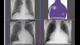 Chest xray  Cardiomegaly or No Cardiomegaly  water bottle sign [upl. by Philomena]