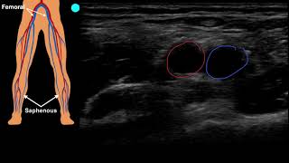 POCUS Venous Access  Part 1 [upl. by Mayfield]