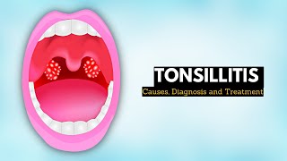 Tonsils and Adenoids  Boys Town Ear Nose amp Throat Institute [upl. by Cirre]