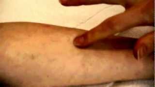 How to take a TB Skin Test [upl. by Nuahsak]