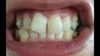 Invisalign Full Timelapse [upl. by Hgielrac]