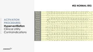 ACTIVATION PROCEDURES ON EEG  LEARN ADULT EEG [upl. by Harli]