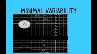 Topic 26 Intrapartum Fetal Surveillance [upl. by Agee961]